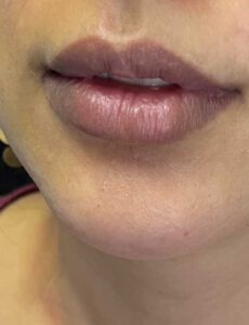 dermal fillers in lips and chin